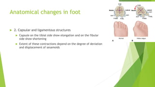 Anatomical changes in foot
 2. Capsular and ligamentous structures
 Capsule on the tibial side show elongation and on the fibular
side show shortening
 Extent of these contractions depend on the degree of deviation
and displacement of sesamoids
 