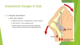 Anatomical changes in foot
 3. Muscles and tendons:
 With axial rotation:
 Abductor halluces – NO Abduction, works as flexor
 Short flexors – Aid in adductor pull’
 Bowstringed extensors and laterally displaced
flexors further accentuste the valgus deformity
 
