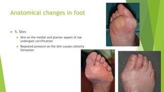 Anatomical changes in foot
 5. Skin:
 Skin on the medial and plantar aspect of toe
undergoes cornification
 Repeated pressure on the skin causes callosity
formation
 