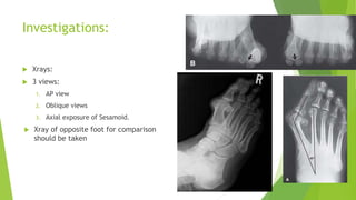 Investigations:
 Xrays:
 3 views:
1. AP view
2. Oblique views
3. Axial exposure of Sesamoid.
 Xray of opposite foot for comparison
should be taken
 