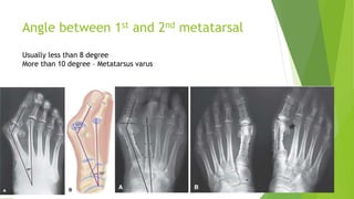 Angle between 1st and 2nd metatarsal
Usually less than 8 degree
More than 10 degree – Metatarsus varus
 