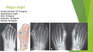 Valgus angle
Usually between 10-15 degree
Depending on angle
Mild- 20 degree
Moderate -30 degree
Marked- 40 degree
 