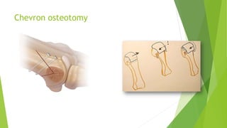 Chevron osteotomy
 