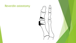 Reverdin osteotomy
 