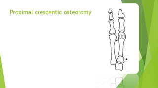 Proximal crescentic osteotomy
 