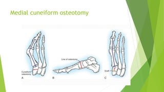 Medial cuneiform osteotomy
 