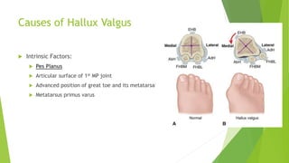 Causes of Hallux Valgus
 Intrinsic Factors:
 Pes Planus
 Articular surface of 1st MP joint
 Advanced position of great toe and its metatarsal.
 Metatarsus primus varus
 