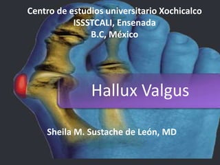 Sheila M. Sustache de León, MD
Centro de estudios universitario Xochicalco
ISSSTCALI, Ensenada
B.C, México
Hallux Valgus
 