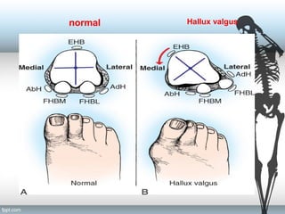 normal Hallux valgus
 