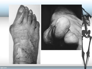 Pronated Toe Fig 6
 