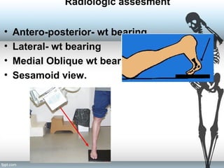 Radiologic assesment
• Antero-posterior- wt bearing
• Lateral- wt bearing
• Medial Oblique wt bearing
• Sesamoid view.
 