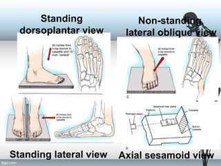 Standing
dorsoplantar view
Non-standing
lateral oblique view
Standing lateral view Axial sesamoid view
 