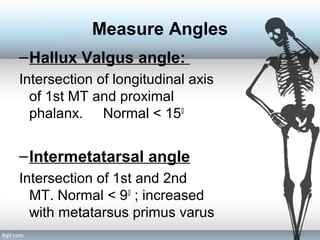 Measure Angles
–Hallux Valgus angle:
Intersection of longitudinal axis
of 1st MT and proximal
phalanx. Normal < 150
–Intermetatarsal angle
Intersection of 1st and 2nd
MT. Normal < 90
; increased
with metatarsus primus varus
 