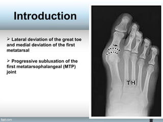  Lateral deviation of the great toe
and medial deviation of the first
metatarsal
 Progressive subluxation of the
first metatarsophalangeal (MTP)
joint
Introduction
 