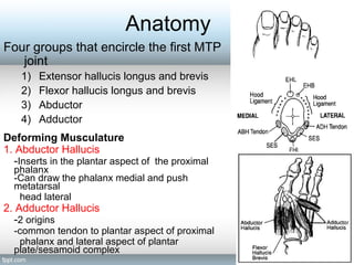 Anatomy
Four groups that encircle the first MTP
joint
1) Extensor hallucis longus and brevis
2) Flexor hallucis longus and brevis
3) Abductor
4) Adductor
Deforming Musculature
1. Abductor Hallucis
-Inserts in the plantar aspect of the proximal
phalanx
-Can draw the phalanx medial and push
metatarsal
head lateral
2. Adductor Hallucis
-2 origins
-common tendon to plantar aspect of proximal
phalanx and lateral aspect of plantar
plate/sesamoid complex
 