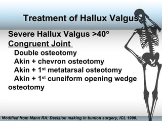 Severe Hallux Valgus >40Severe Hallux Valgus >40°°
Congruent Joint
Double osteotomy
Akin + chevron osteotomy
Akin + 1st
metatarsal osteotomy
Akin + 1st
cuneiform opening wedge
osteotomy
Modified from Mann RA: Decision making in bunion surgery, ICL 1990.
Treatment of Hallux ValgusTreatment of Hallux Valgus
 