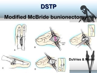 DSTPDSTP
Modified McBride bunionectomy
DuVries & Mann
 