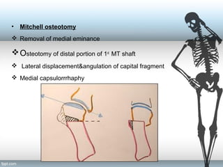 • Mitchell osteotomy
 Removal of medial eminance
Osteotomy of distal portion of 1st
MT shaft
 Lateral displacement&angulation of capital fragment
 Medial capsulorrrhaphy
 
