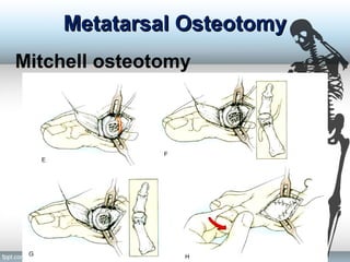 Metatarsal OsteotomyMetatarsal Osteotomy
Mitchell osteotomy
 