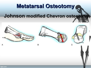 Metatarsal OsteotomyMetatarsal Osteotomy
Johnson modified Chevron osteotomy
 