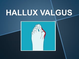 HALLUX VALGUS
 