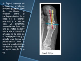 Hallux Valgus PPTX hallux-valgus-pptx