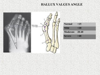 HALLUX VALGUS ANGLE
Normal <15
Mild <20
Moderate 20-40
Severe >40
 