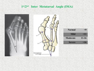 1st
/2nd
Inter Metatarsal Angle (IMA)
Normal <9
Mild <11
Moderate 11-16
Severe >16
 