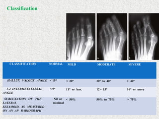 CLASSIFICATION NORMAL MILD MODERATE SEVERE
HALLUX VALGUS ANGLE < 15* < 20° 20° to 40° > 40°
1-2 INTERMETATARSAL
ANGLE
< 9* 11° or less. 12 - 15° 16° or more
SUBLUXATION OF THE
LATERAL
SESAMOID, AS MEASURED
ON AN AP RADIOGRAPH
Nil or
minimal
< 50% 50% to 75% > 75%
Classification
 