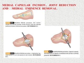 MEDIAL CAPSULAR INCISION , JOINT REDUCTION
AND MEDIAL EMINENCE REMOVAL.
 