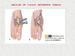 RELEASE OF VALGUS DEFORMING FORCES
 
