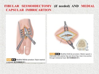 FIBULAR SESMOIDECTOMY (if needed) AND MEDIAL
CAPSULAR IMBRICARTION
 