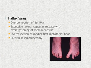  Hallux Varus
 Overcorrection of 1st IMA
 Excessive lateral capsular release with
overtightening of medial capsule
 Overresection of medial first metatarsal head
 Lateral sesamoidectomy
 