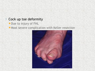  Cock up toe deformity
 Due to injury of FHL
 Most severe complication with Keller resection
 