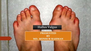 PRESENTED
BY
MD. MONSUR RAHMAN
Hallux Valgus
 