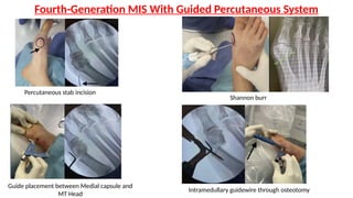 Mis Incision Hallux Valgus Principles and Management | PPTX