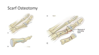 principles-of-management-of-hallux-valgus-pptx