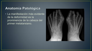 • La manifestación más evidente
de la deformidad es la
prominencia de la cabeza del
primer metatarsiano.
 