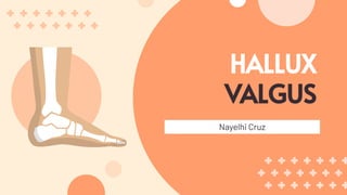 HALLUX
VALGUS
Nayelhi Cruz
 
