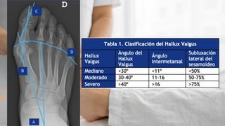 Hallux valgus exposicion con imagenes y maniobras | PDF