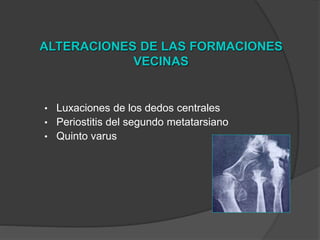 ALTERACIONES DE LAS FORMACIONES
VECINAS
• Luxaciones de los dedos centrales
• Periostitis del segundo metatarsiano
• Quinto varus
 