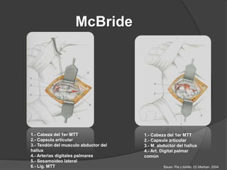 McBride
1.- Cabeza del 1er MTT
2.- Capsula articular
3.- Tendón del musculo abductor del
hallux
4.- Arterias digitales palmares
5.- Sesamoideo lateral
6.- Lig. MTT
1.- Cabeza del 1er MTT
2.- Capsula articular
3.- M. abductor del hallux
4.- Art. Digital palmar
común
Bauer. Pie y tobillo. (5) Marban. 2004
 