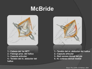 McBride
1.- Cabeza del 1er MTT
2.- Falange prox. del hallux
3.- Capsula articular
4.- Tendón del m. abductor del
hallux
1.- Tendón del m. abductor del hallux
2.- Capsula articular
3.- Red venosa dorsal del pie
4.- N. cutáneo dorsal medial
Bauer. Pie y tobillo. (5) Marban. 2004
 