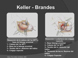 Keller - Brandes
Cobertura con colgajo capsular :
estirar porción plantar par
reponer los sesamoideos.
1.- Falange proxima...