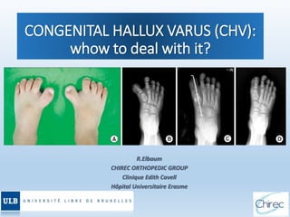 CONGENITAL HALLUX VARUS (CHV):
whow to deal with it?
R.Elbaum
CHIREC ORTHOPEDIC GROUP
Clinique Edith Cavell
Hôpital Universitaire Erasme
 