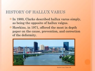 HISTORY OF HALLUX VARUS
  In 1900, Clarke described hallux varus simply,
   as being the opposite of hallux valgus.
  Hawkins, in 1971, offered the most in depth
   paper on the cause, prevention, and correction
   of the deformity.




                                Hawkins’ home: Toledo, OH
 