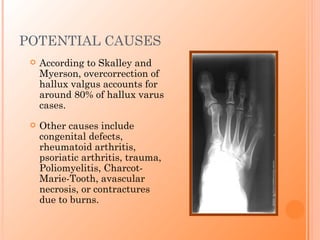 POTENTIAL CAUSES
    According to Skalley and
     Myerson, overcorrection of
     hallux valgus accounts for
     around 80% of hallux varus
     cases.
    Other causes include
     congenital defects,
     rheumatoid arthritis,
     psoriatic arthritis, trauma,
     Poliomyelitis, Charcot-
     Marie-Tooth, avascular
     necrosis, or contractures
     due to burns.
 