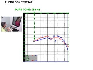 AUDIOLOGY TESTING:
PURE TONE: 250 Hz
 