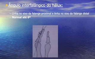 • Ângulo interfalângico do hálux:
– Linha no eixo da falange proximal e linha no eixo da falange distal
– Normal até 6º
 
