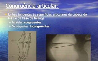 Congruência articular:
• Linhas tangentes às superfícies articulares da cabeça do
MTT e da base da falange
– Paralelas: congruentes
– Convergentes: incongruentes
 